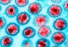 U SAD-u izliječena beba zaražena HIV-om HIV