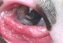 U oku bolesnog psa pronađen zarazni očni crv koji se lako prenosi i na čovjeka