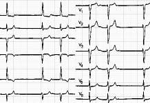 Prelazak na ljetno računanje vremena uzrokuje srčani udar