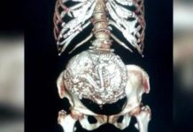 Starica 60 godina nosila fetus u stomaku