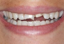 Njemački stomatolozi: Sačuvajte izbijeni zub u hladnom mlijeku