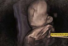 Rodila se beba bez lica, ginekolog koji je pratio trudnoću pod istragom