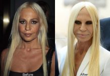 donatella-versace-plastic-surgery