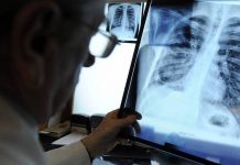 Koronavirus na pluća djeluje kao kombinacija SARS-a i AIDS-a i može ih trajno oštetiti