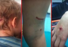 Psi lutalice izgrizli petogodišnjeg dječaka, hitno prebačen u zeničku bolnicu