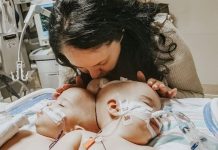 Blizanke rođene spojenih glava uspješno razdvojene nakon 24-satne operacije
