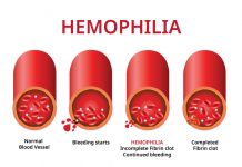 Danas se obilježava Svjetski dan hemofilije