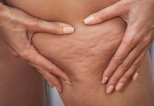 Tri dodatka prehrani koja će vam pomoći da se riješite celulita