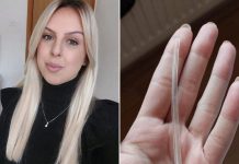 Selmi u grudima ostala silikonska cijev nakon operacije tumora u BiH