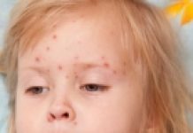 WHO i Unicef upozoravaju: Broj slučajeva ospica u svijetu „eksplodirao“