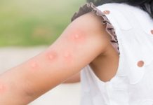 U SAD-u potvrđeni prvi slučajevi majmunskih boginja kod djece