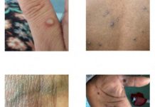 Kalifornija proglasila vanredno stanje zbog majmunskih boginja