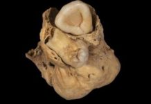 U tijelu drevne Egipćanke pronađen čudan tumor sa zubima